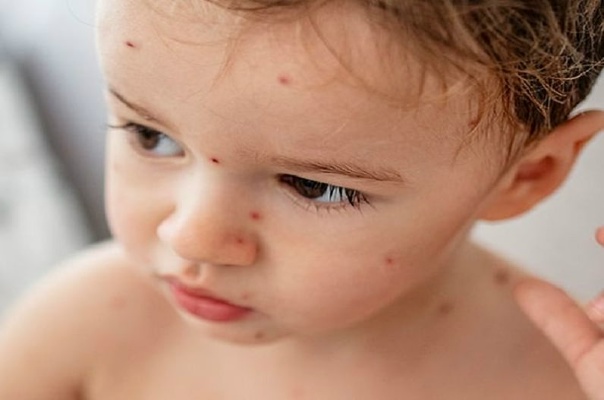 Қазақстан 100 жылдық тарихы бар ауруға ем таппады. Неге?